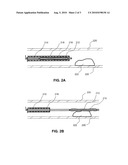 LOCAL DELIVERY OF WATER-SOLUBLE OR WATER-INSOLUBLE THERAPEUTIC AGENTS TO THE SURFACE OF BODY LUMENS diagram and image