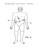 CANNULA WITH A DEPLOYABLE EXTERNAL THREAD diagram and image