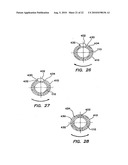 CANNULA WITH A DEPLOYABLE EXTERNAL THREAD diagram and image