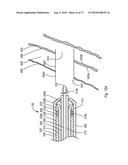 EXPANDABLE INTRODUCER SHEATH TO PRESERVE GUIDEWIRE ACCESS diagram and image