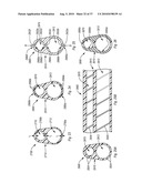 EXPANDABLE INTRODUCER SHEATH TO PRESERVE GUIDEWIRE ACCESS diagram and image