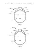 EXPANDABLE INTRODUCER SHEATH TO PRESERVE GUIDEWIRE ACCESS diagram and image