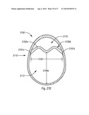 EXPANDABLE INTRODUCER SHEATH TO PRESERVE GUIDEWIRE ACCESS diagram and image