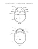 EXPANDABLE INTRODUCER SHEATH TO PRESERVE GUIDEWIRE ACCESS diagram and image