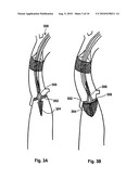 DEVICES, SYSTEMS, AND METHODS FOR VALVE REMOVAL diagram and image