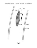 DEVICES, SYSTEMS, AND METHODS FOR VALVE REMOVAL diagram and image