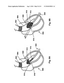 DEVICES, SYSTEMS, AND METHODS FOR VALVE REMOVAL diagram and image