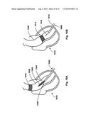 DEVICES, SYSTEMS, AND METHODS FOR VALVE REMOVAL diagram and image