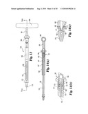 Method and instrumentation for posterior interbody fusion diagram and image