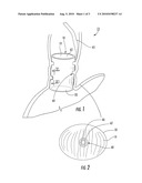 MUCOSAL CAPTURE FIXATION OF MEDICAL DEVICE diagram and image