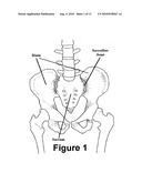 Method and apparatus for minimally invasive treatment of unstable pelvic ring injuries diagram and image