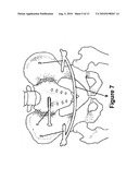 Method and apparatus for minimally invasive treatment of unstable pelvic ring injuries diagram and image