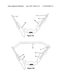 Method and apparatus for minimally invasive treatment of unstable pelvic ring injuries diagram and image