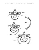 Intervertebral disc inserting device diagram and image