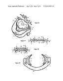 Intervertebral disc inserting device diagram and image