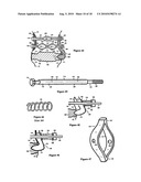 Intervertebral disc inserting device diagram and image