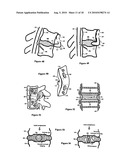 Intervertebral disc inserting device diagram and image