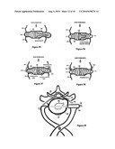 Intervertebral disc inserting device diagram and image