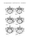 Intervertebral disc inserting device diagram and image