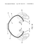 DEVICES FOR VESTIBULAR OR CRANIAL NERVE STIMULATION diagram and image