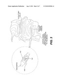  APPARATUS, SYSTEM AND METHOD FOR THERAPEUTIC TREATMENT OF OBSTRUCTIVE SLEEP APNEA diagram and image