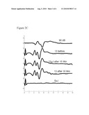 COCHLEA STIMULATOR diagram and image