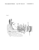 COCHLEA STIMULATOR diagram and image