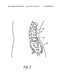 COMPOSITIONS AND METHODS FOR TREATING POST-OPERATIVE PAIN USING BUPIVACAINE AND AN ANTI-ONFLAMMATORY AGENT diagram and image