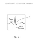 SYSTEM FOR PLACEMENT OF A CATHETER INCLUDING A SIGNAL-GENERATING STYLET diagram and image