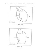 Apparatus And Method For Cardiac Ablation diagram and image