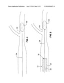 SYSTEM AND METHOD FOR TREATING ISCHEMIC STROKE diagram and image