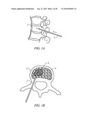 ELECTROSURGICAL METHOD AND APPARATUS FOR REMOVING TISSUE WITHIN A BONE BODY diagram and image