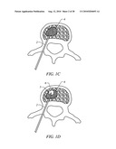 ELECTROSURGICAL METHOD AND APPARATUS FOR REMOVING TISSUE WITHIN A BONE BODY diagram and image