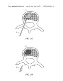 ELECTROSURGICAL METHOD AND APPARATUS FOR REMOVING TISSUE WITHIN A BONE BODY diagram and image