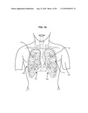 SURGICAL INSTRUMENTS FOR CREATING A PNEUMOSTOMA AND TREATING CHRONIC OBSTRUCTIVE PULMONARY DISEASE diagram and image