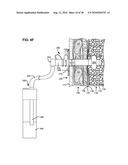 SURGICAL INSTRUMENTS FOR CREATING A PNEUMOSTOMA AND TREATING CHRONIC OBSTRUCTIVE PULMONARY DISEASE diagram and image