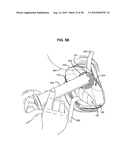 SURGICAL INSTRUMENTS FOR CREATING A PNEUMOSTOMA AND TREATING CHRONIC OBSTRUCTIVE PULMONARY DISEASE diagram and image