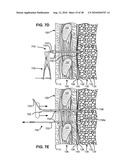 SURGICAL INSTRUMENTS FOR CREATING A PNEUMOSTOMA AND TREATING CHRONIC OBSTRUCTIVE PULMONARY DISEASE diagram and image