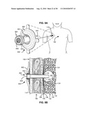 SURGICAL INSTRUMENTS FOR CREATING A PNEUMOSTOMA AND TREATING CHRONIC OBSTRUCTIVE PULMONARY DISEASE diagram and image