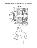 SURGICAL INSTRUMENTS FOR CREATING A PNEUMOSTOMA AND TREATING CHRONIC OBSTRUCTIVE PULMONARY DISEASE diagram and image