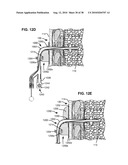 SURGICAL INSTRUMENTS FOR CREATING A PNEUMOSTOMA AND TREATING CHRONIC OBSTRUCTIVE PULMONARY DISEASE diagram and image