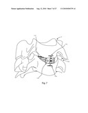 INTERVERTEBRAL IMPLANT WITH INTEGRATED FIXATION diagram and image