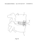 INTERVERTEBRAL IMPLANT WITH INTEGRATED FIXATION diagram and image