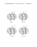 INTERVERTEBRAL IMPLANT WITH INTEGRATED FIXATION diagram and image