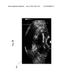 SYSTEM AND METHOD FOR FUSING REAL-TIME ULTRASOUND IMAGES WITH PRE-ACQUIRED MEDICAL IMAGES diagram and image