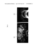 SYSTEM AND METHOD FOR FUSING REAL-TIME ULTRASOUND IMAGES WITH PRE-ACQUIRED MEDICAL IMAGES diagram and image