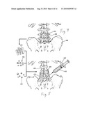 ENHANCED MEDICAL IMPLANT diagram and image