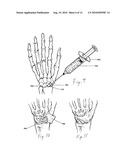 ENHANCED MEDICAL IMPLANT diagram and image