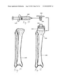 ENHANCED MEDICAL IMPLANT diagram and image