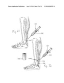 ENHANCED MEDICAL IMPLANT diagram and image